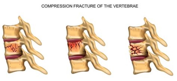 A Comprehensive Guide To Cracked T12 Vertebrae: Causes, Symptoms, And Treatment