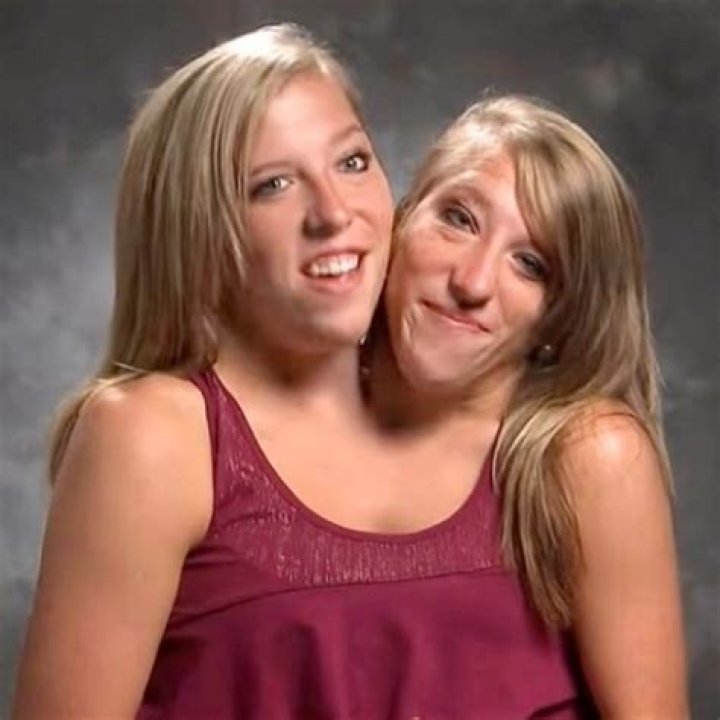 A Reflection On Conjoined Twins