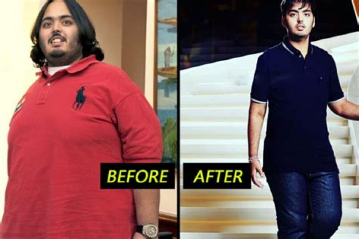 Anant Ambani's Weight Loss Surgery: A Journey To Transformation