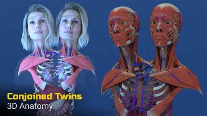 Astonishing Conjoined Twins Anatomy: A Comprehensive Guide To Understanding Their Uniqueness