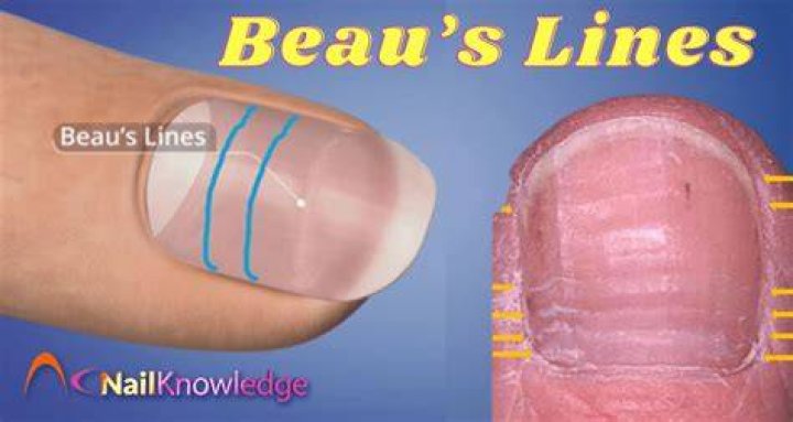 Beau's Lines: The Revealing Ridges On Fingernails