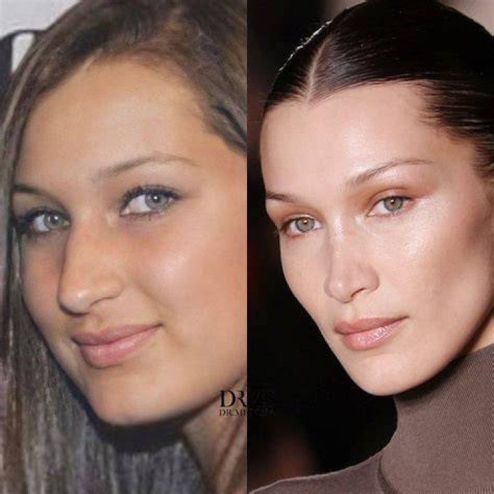 Bella Hadid's Nose Job Transformation: Before And After Photos