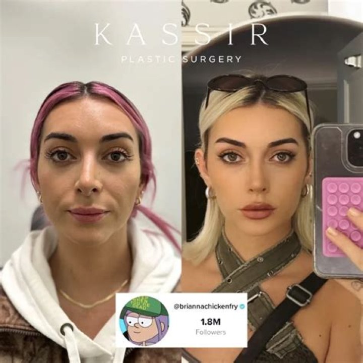 Brianna Chickenfry's Nose Job Unveiled