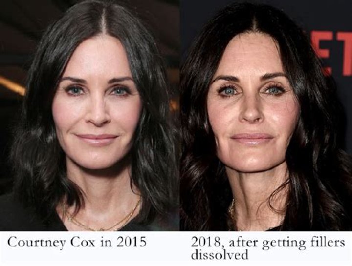Courteney Cox: Ive had all my fillers dissolved. Im as natural as I can be