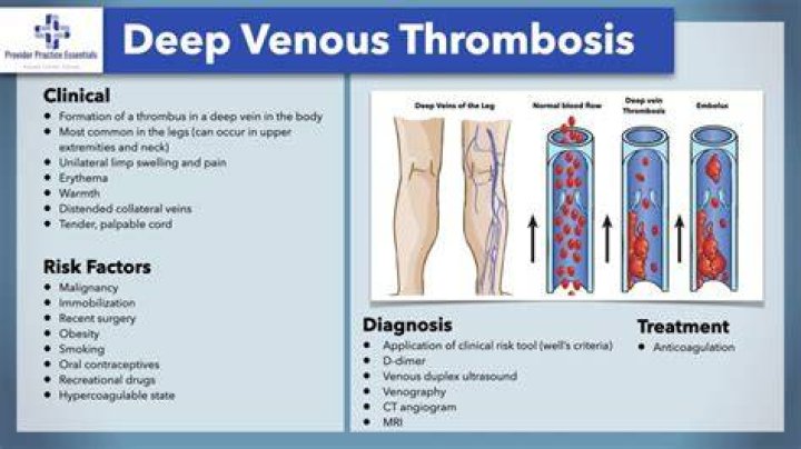 Deep Vein Thrombosis Of The Right Calf: ICD-10 Classification