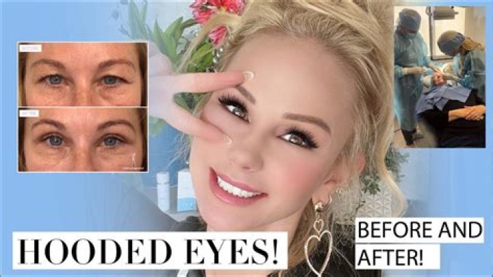 Discover The Secrets Of Celebrity Hooded Eye Surgery