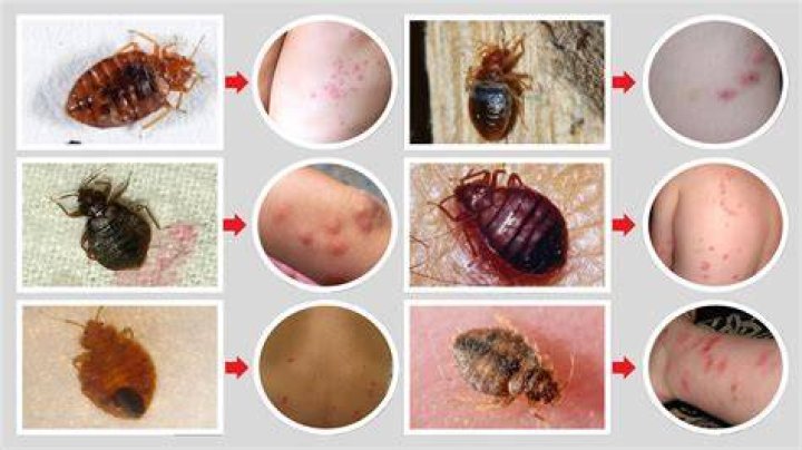 Do bedbugs bite your scalp?