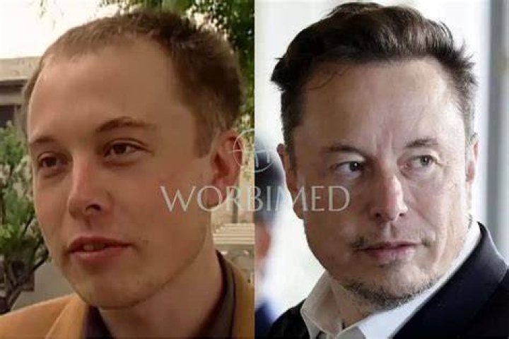 Elon Musk's Hair Restoration Journey: From Thinning To Confidence