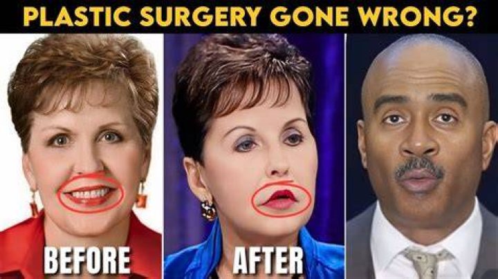 Exploring Joyce Meyer Before Plastic Surgery