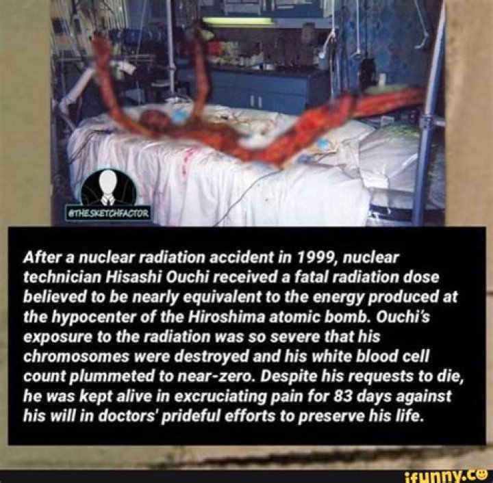 Horrifying Aftermath: Hisashi Ouchi's Real Photos After Radiation Exposure