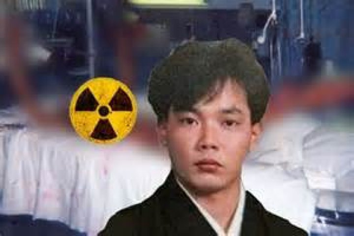 Horrifying Photos Of Hisashi Ouchi: A Case Study Of Radiation Exposure