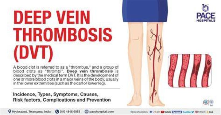 ICD-10 Codes To Diagnose And Rule Out Deep Vein Thrombosis (DVT)