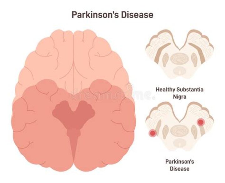 Is Chris Isaak Battling Parkinson's Disease?