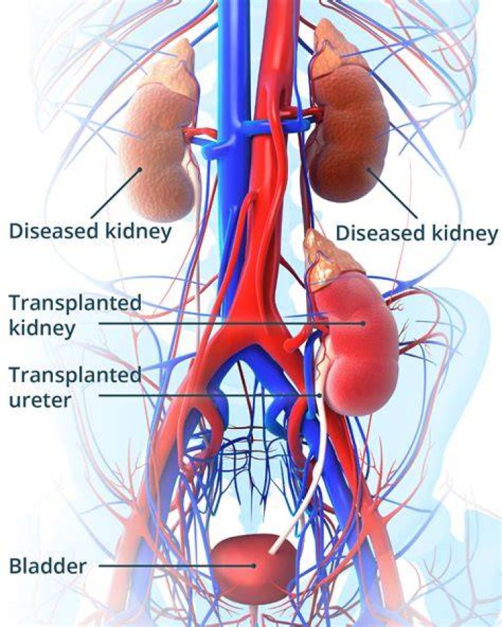 Kidney Transplant Scar Pictures | Comprehensive Guide