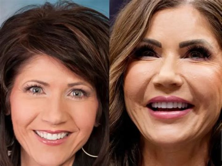 Kristi Noem's Plastic Surgery Transformation: Before And After