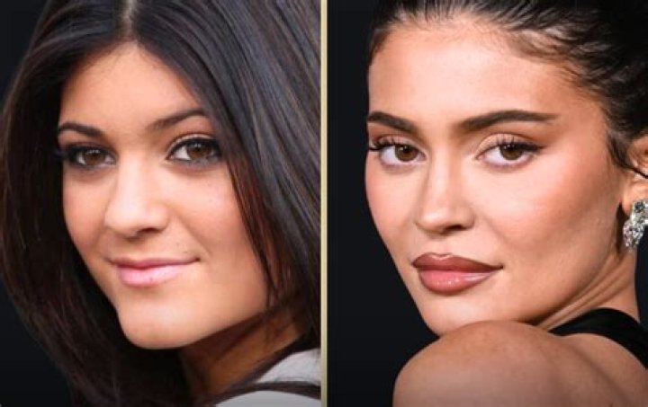 Kylie Jenner Brazilian Butt Lift More Plastic Surgery? (PHOTOS)
