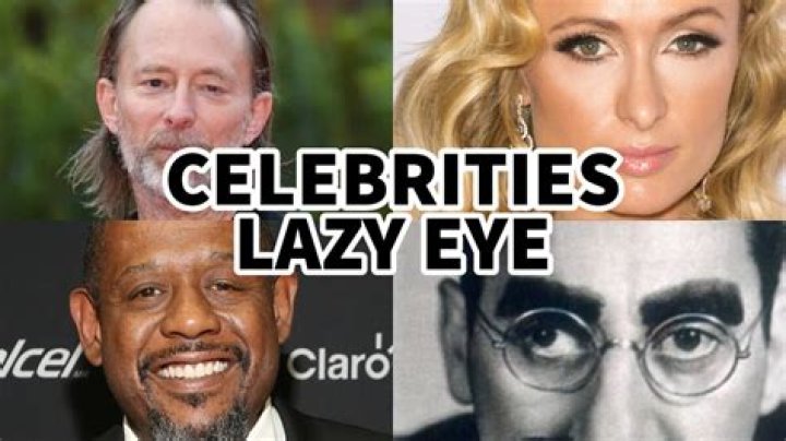 Mesmerizing Performances: Actors With The Allure Of A Lazy Eye