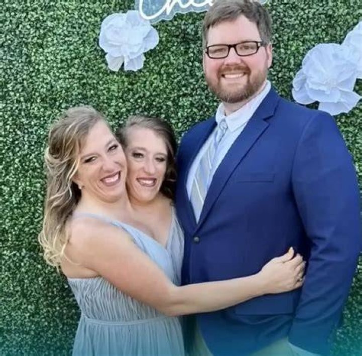 Remarkable Union: Married Conjoined Twins