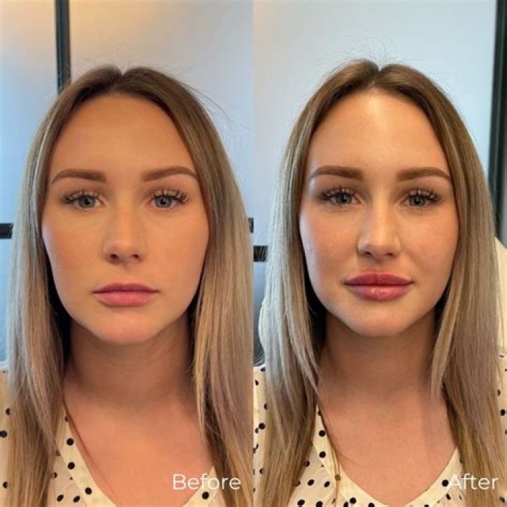 Sabrina Carpenter's Lips: Before And After The Transformation