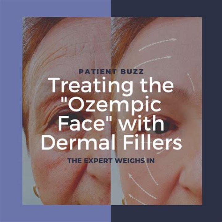 The Impact Of Ozempic On Lupus: A Comprehensive Guide