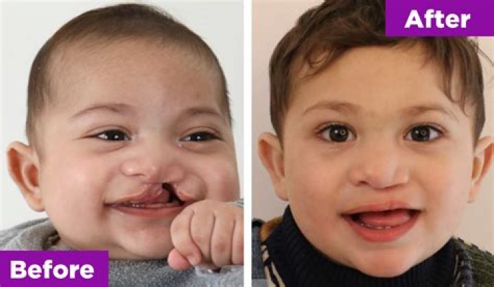 The Inspiring Transformation Of Actors With Cleft Palate: Before And After