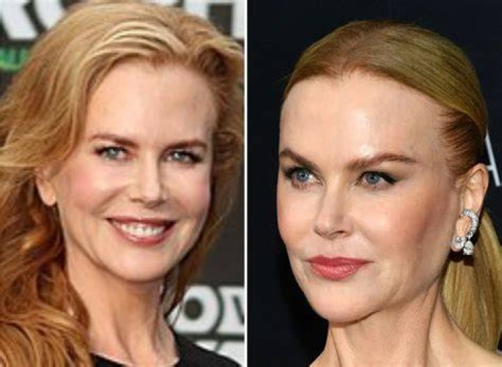 The Real Truth Behind Nicole Kidman's Plastic Surgery Rumors