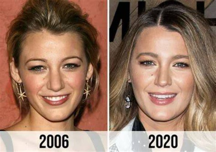 The Truth About Blake Lively's Plastic Surgery: A Comprehensive Examination
