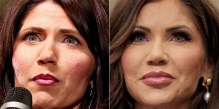 The Truth About Kristi Noem's Plastic Surgeries