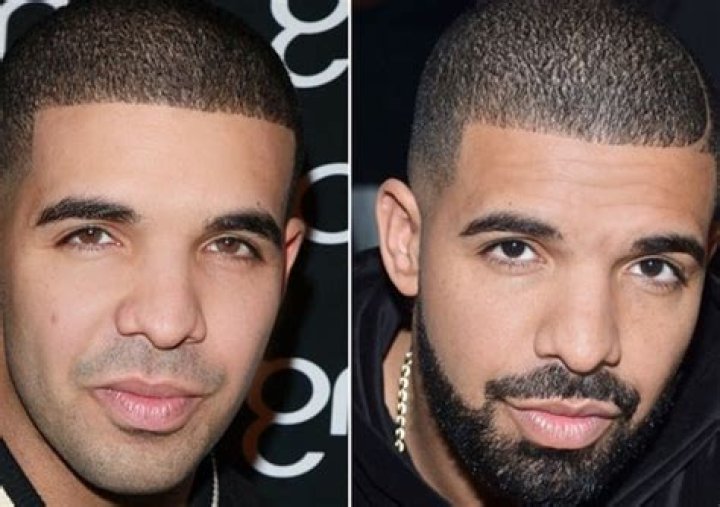 The Ultimate Guide To Drake's Plastic Surgery Revelations