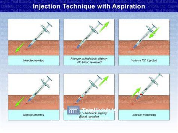 The Vital Guide To Aspiration Injection: Benefits, Procedures, And Recovery