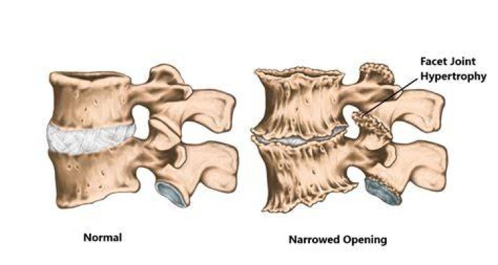 Understand Facet Joint Hypertrophy: Definition And Implications