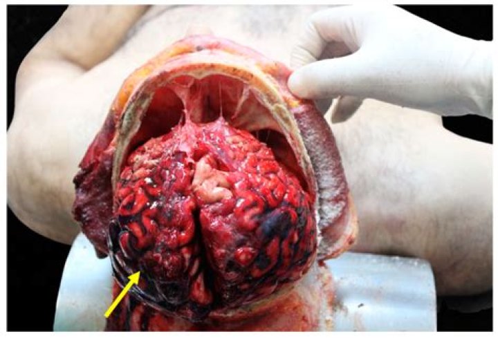 Understanding Rapper Autopsies: Causes, Controversies, And Aftermath