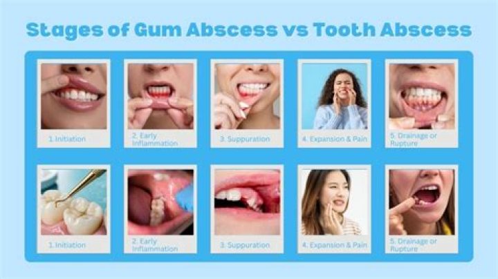 Understanding The Difference Between Gum Abscess And Tooth Abscess