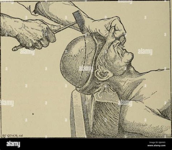 Unraveling The Mystery Of Tarrare's Organs After Death: A Post-Mortem Examination
