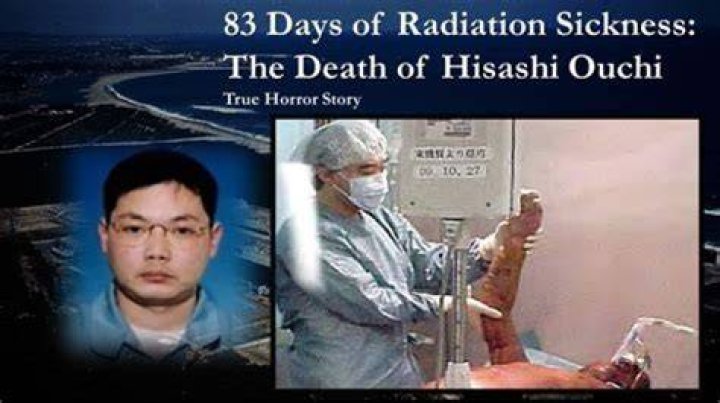 Unveiling The Aftermath: Hisashi Ouchi's Journey Post-Radiation Exposure