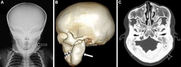 Unveiling The Enigmatic World Of Macrocephaly: Discoveries And Insights