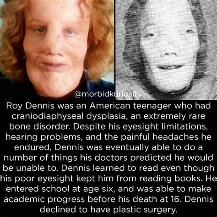 Unveiling The Extraordinary Life Of Rocky Dennis: Discoveries And Insights