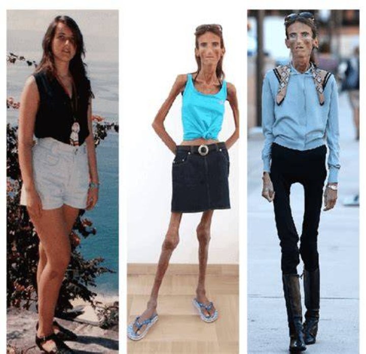 Unveiling The Secrets Of Extreme Thinness: The Skinniest Person Alive