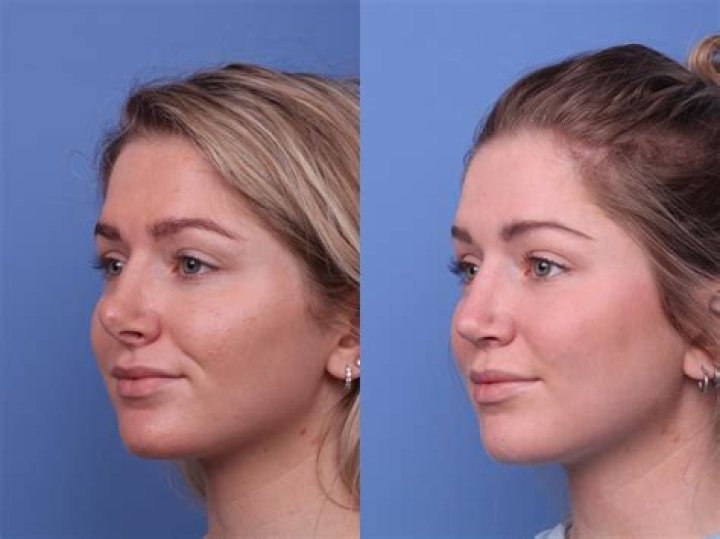 Zoe Saldaa's Nose Job: Before And After